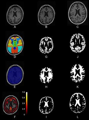 Pypes: Workflows for Processing Multimodal Neuroimaging Data